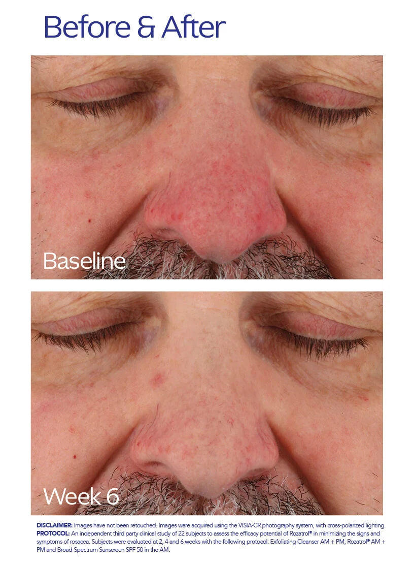 ZO Skin Health Rozatrol – QualDerm Partners ZO Skin Health Rozatrol – QualDerm Partners